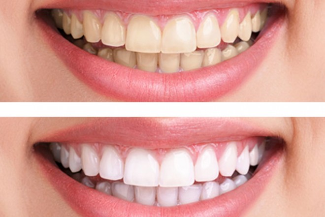 Így fehérítheted a fogaidat otthon, szinte ingyen!